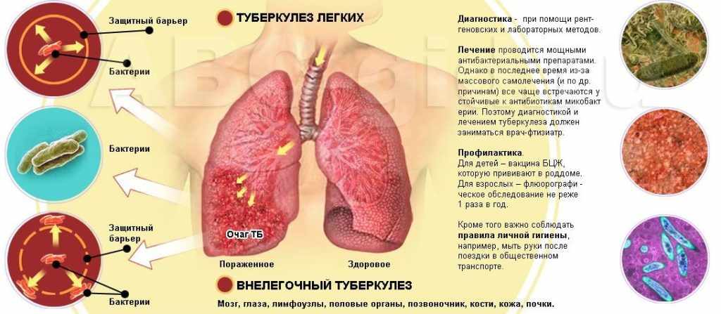 Как можно вылечить туберкулез?
