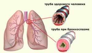 Бронхоспазм - что это такое?