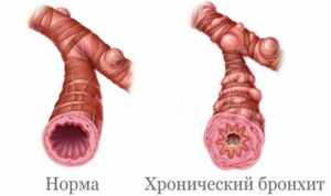 Бронхит у взрослых — симптомы и лечение в домашних условиях