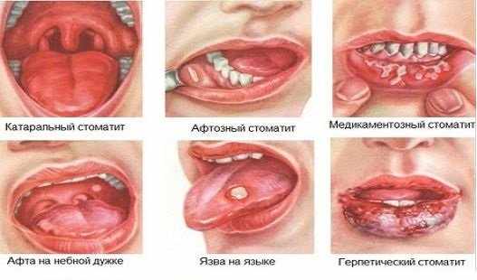 стоматит