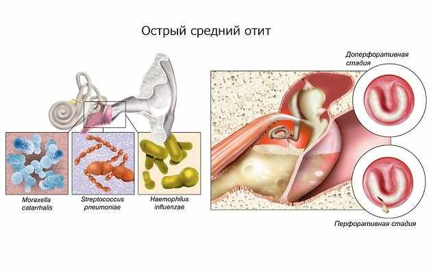 Какие антибиотики принимать при отите у взрослых?