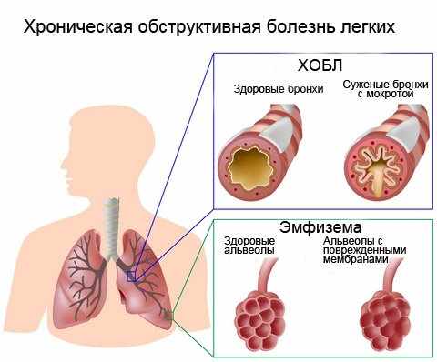 что такое хобл