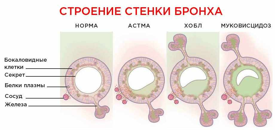 виды астмы