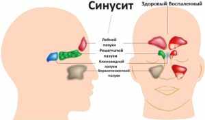 Чем синусит отличается от гайморита?
