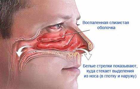 насморк