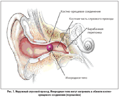 инородное тело в ухе