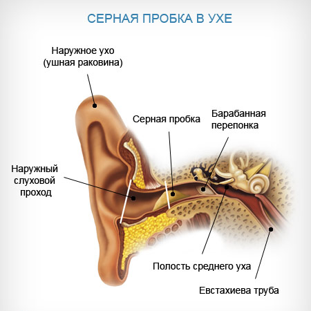 Серная пробка в ухе