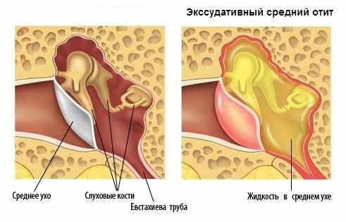 экссудативный отит