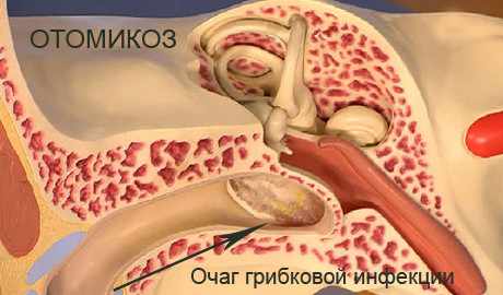 отомикоз 1