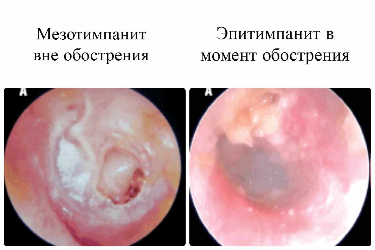 мезотимпанит и эпитимпанит