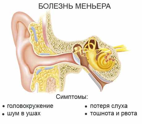 болезнь меньера