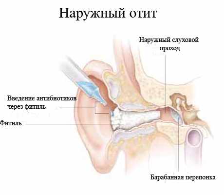 наружный отит