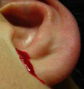 кровь из уха