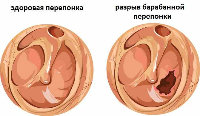 мезотимпанит