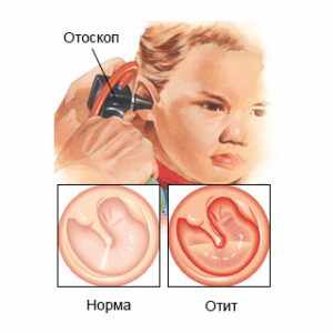 отит