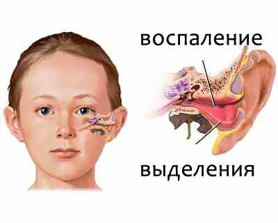отит у детей
