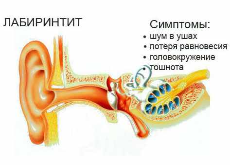 лабиринтит