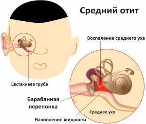 отит среднего уха