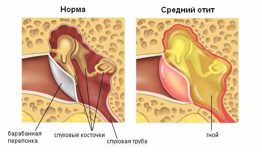 средний отит