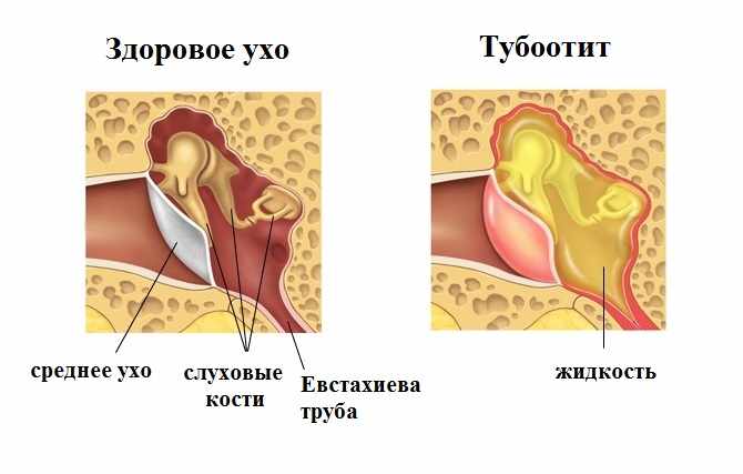 хронический тубоотит