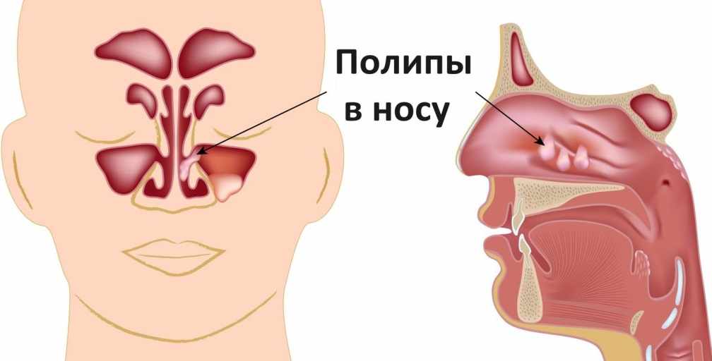 polpipy-v-nosu