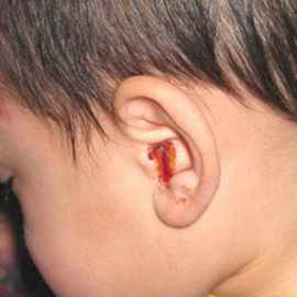 кровотечение из уха