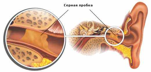 Серная пробка приводит к заложенности