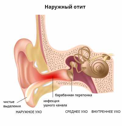 наружный отит