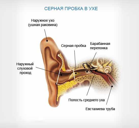 серная пробка в ушах