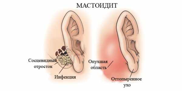 Мастоидит