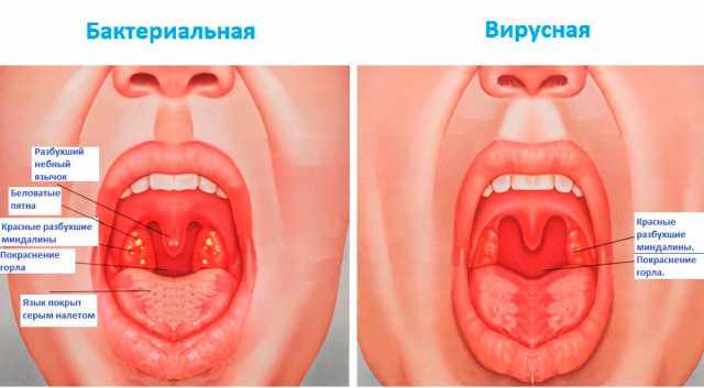 бактериальная и вирусная ангина