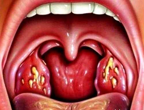 angina6