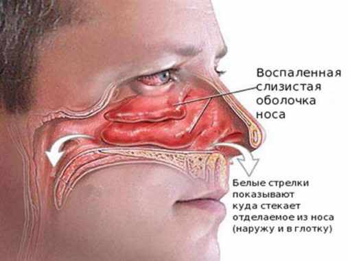 Как избавиться от соплей?